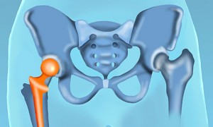 Hip replacement diagram 