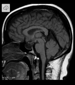 Gadolinium deposition disease brain poisoning