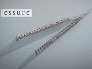 Essure nickel metal allergy 