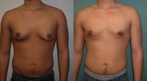  Gynecomastia from Risperdal