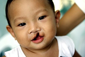 cleft lip cleft palate