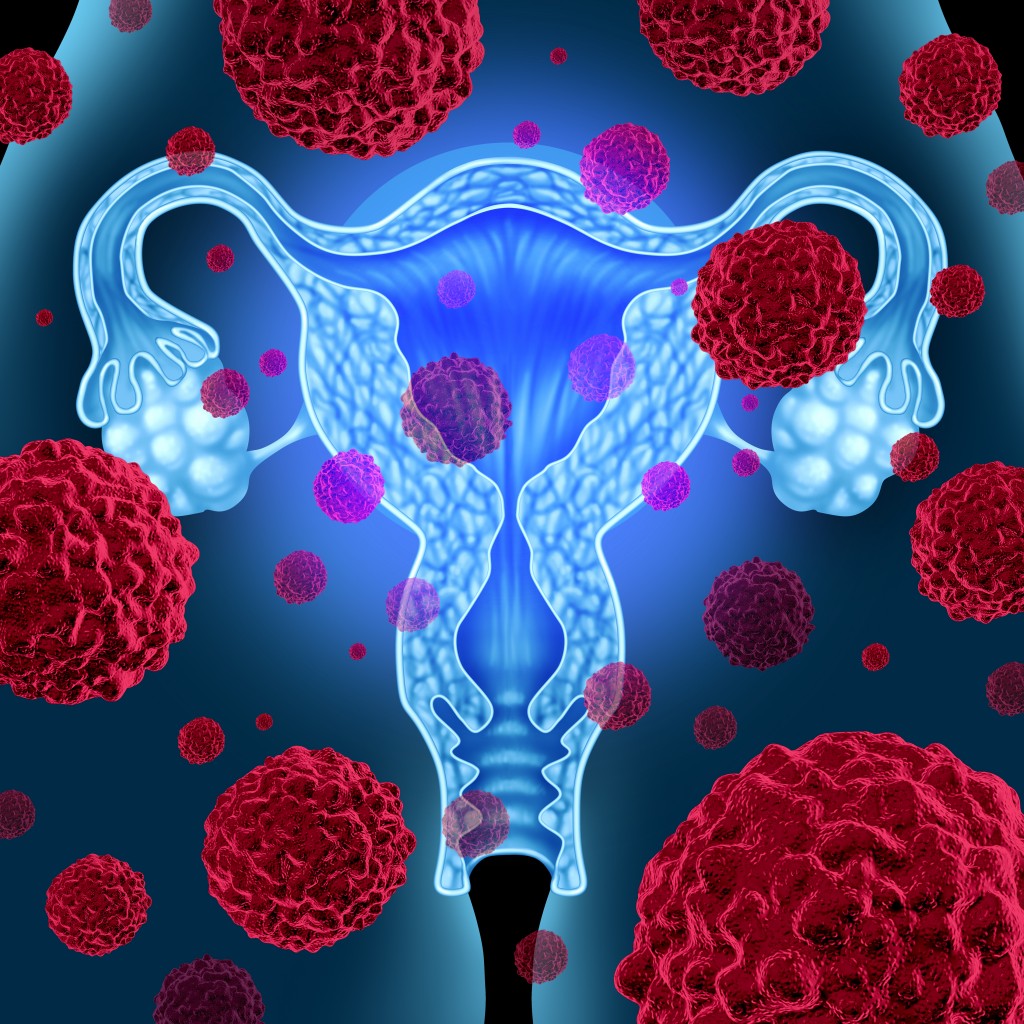 Uterine Sarcoma