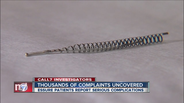 Essure Coils