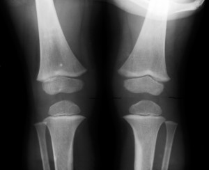 total knee replacement