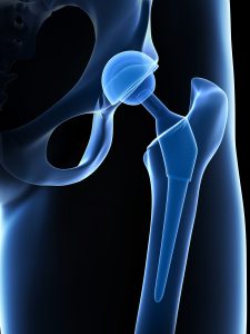 depuy hip replacement lawsuit