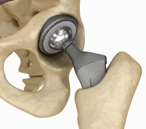 Metal on Metal Hip replacement parts