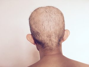 Taxotere hair loss lawsuit