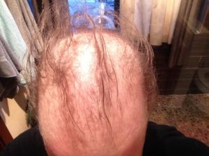 Docetaxel Hair Loss 