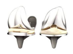 tibial loosening of the DePuy ATTUNE knee replacement 