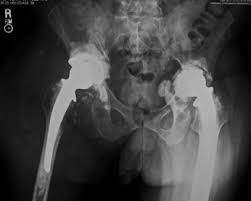 scan showing metallosis in hip