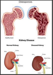 Osteoporosis & Kidney Disease TDF HIV